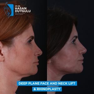 female neck lift in turkey