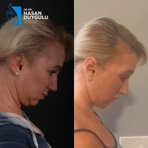 facelift-before-and-after-photos-turkey