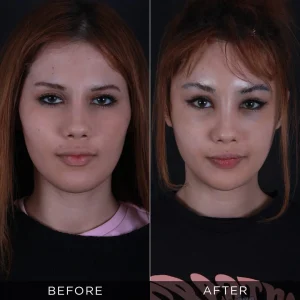 Fox Eyes Before After Photos in Turkey