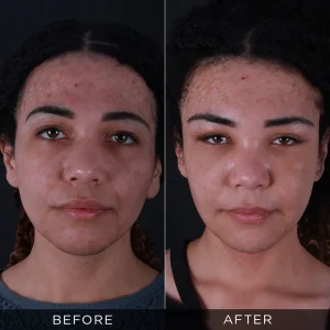 Fox Eyes Before After Photos in Turkey