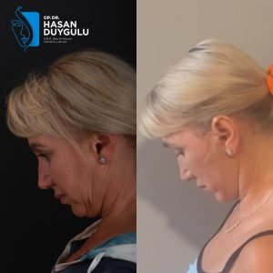 women-facelift-before-and-after-turkey