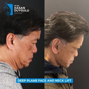 Facelift Before After Photos in Turkey