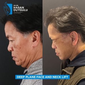 Facelift Before After Photos in Turkey