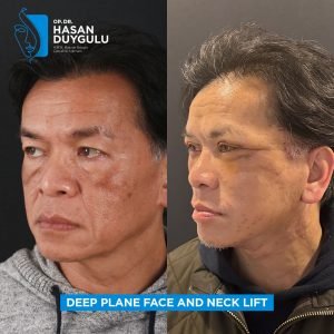 Facelift Before After Photos in Turkey