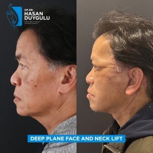 Facelift Before After Photos in Turkey