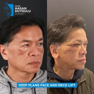 Facelift Before After Photos in Turkey