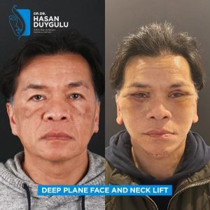 Facelift Before After Photos in Turkey