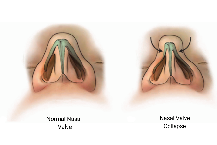 Functional Rhinoplasty in Turkey