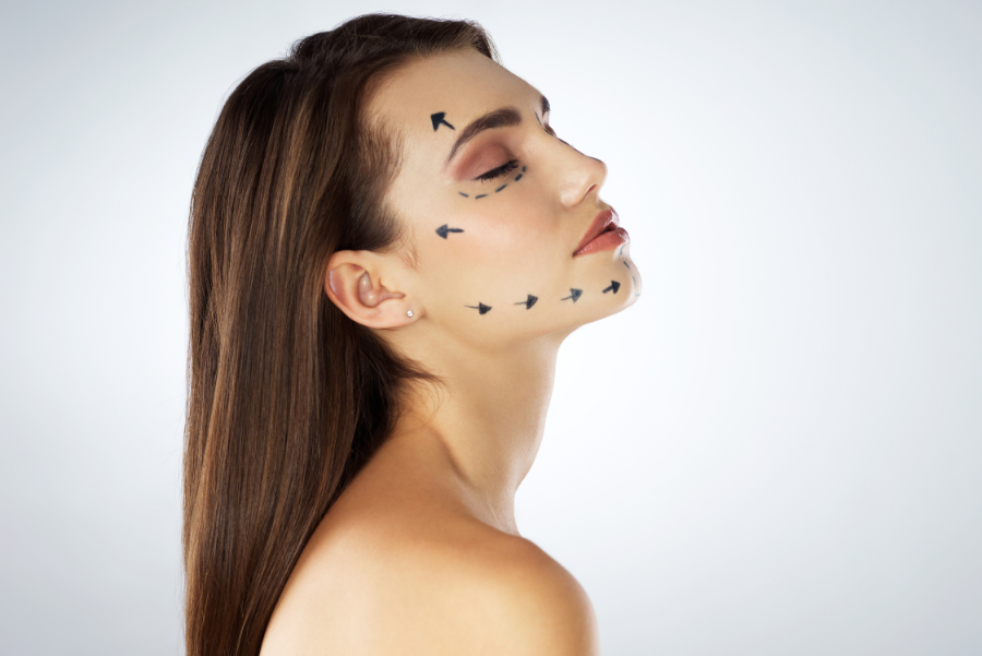Revision Facelift