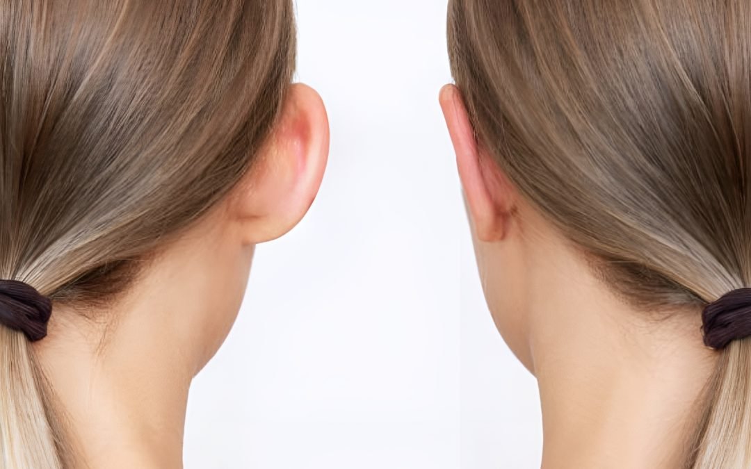 Otoplasty Month By Month Change & Things To Consider