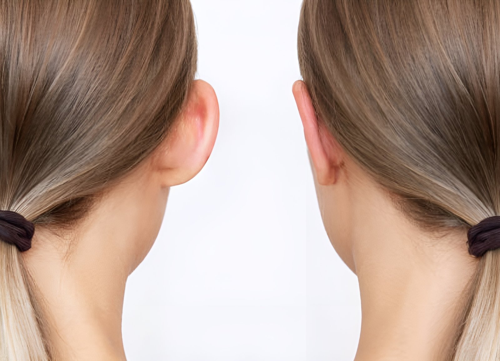 Otoplasty Month By Month Change & Things To Consider