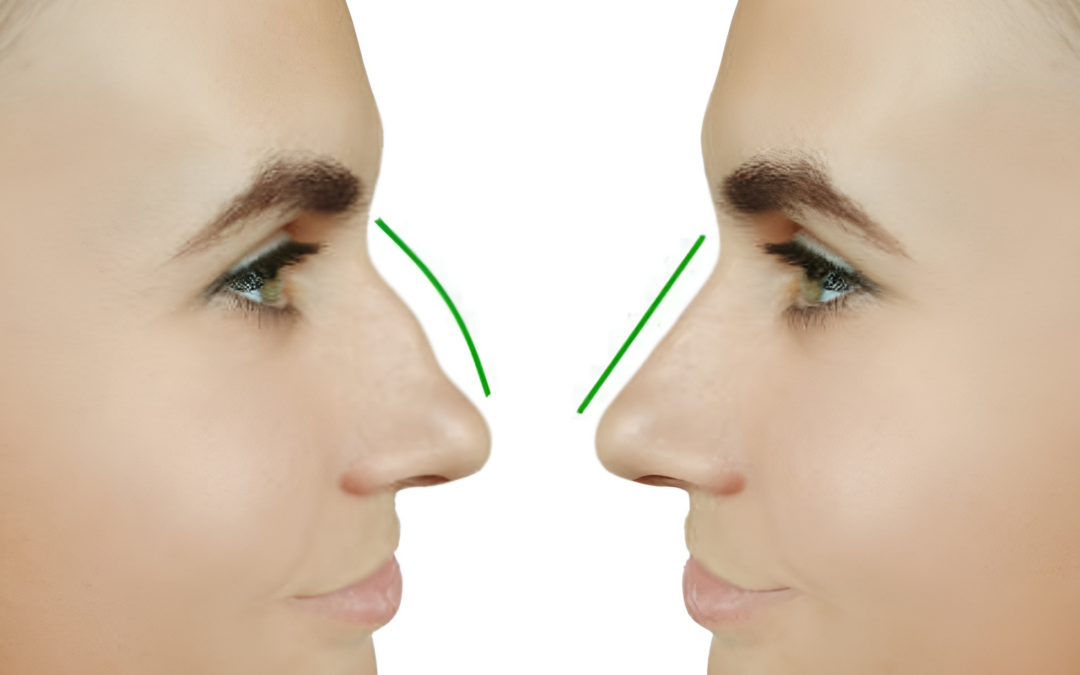 Can Septoplasty and Rhinoplasty Be Done Together?