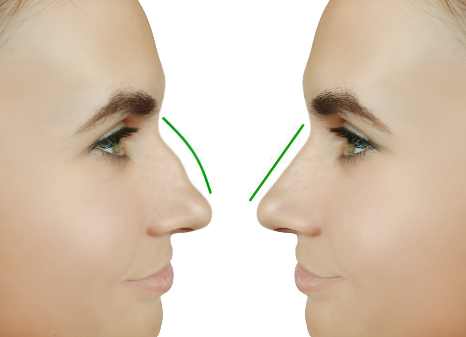 Can Septoplasty and Rhinoplasty Be Done Together?