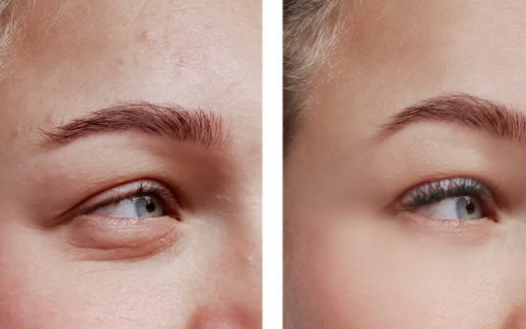 Lower and Upper Blepharoplasty Recovery Timeline: What to Expect