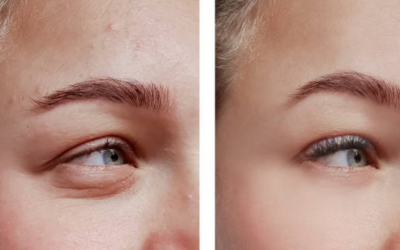 Blepharoplasty (Eyelid Surgery)