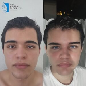 Fox Eyes Before After Photos in Turkey