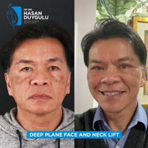 Facelift Before After Photos in Turkey