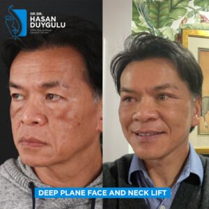 Facelift Before After Photos in Turkey