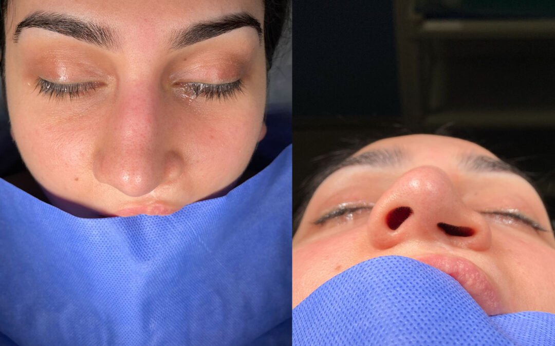 Rhinoplasty in Patients with Cleft Lip / Palate