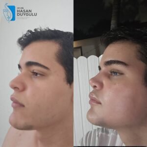 Fox Eyes Before After Photos in Turkey