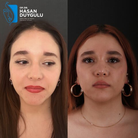 istanbul-rhinoplasty-surgery