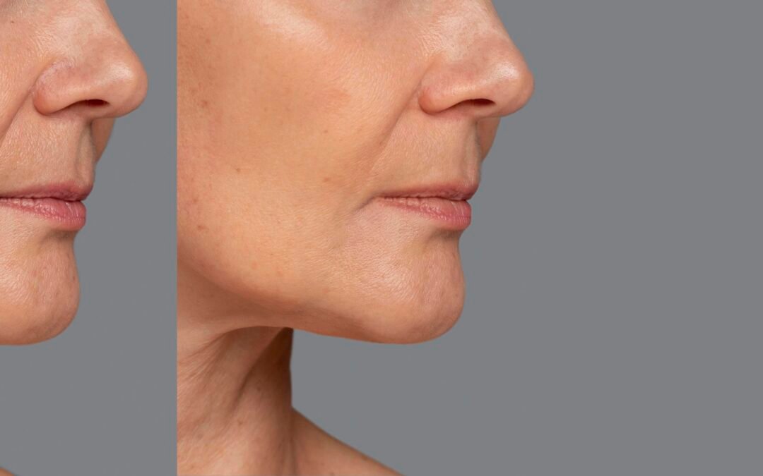 Necklift vs Lower Facelift – What’s the Difference