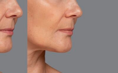 necklift-vs-lower-facelift