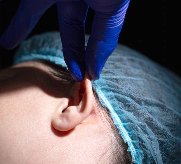 Otoplasty Scarring: Will Ear Surgery Leave Visible Scars?