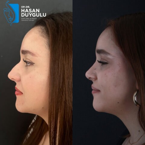 rhinoplasty-faceaesthetics