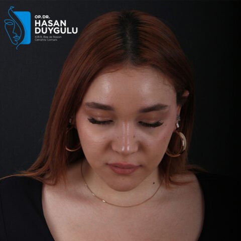 rhinoplasty-istanbul-faceaesthetics