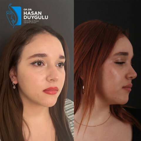 rhinoplasty-surgery-turkey-istanbul