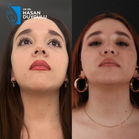 rhinoplasty-turkey-faceaesthetics