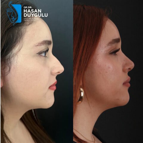 turkey-rhinoplasty-surgery