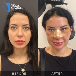 Fox Eyes Before After Photos in Turkey