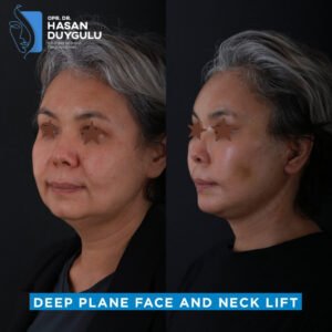 deep-plane-and-neck-lift-surgery-turkey