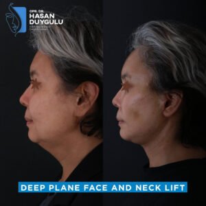 deep-plane-and-necklift