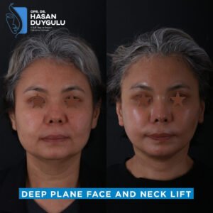 Facelift Before After Photos in Turkey