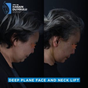 Facelift Before After Photos in Turkey