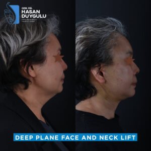 deep-plane-neck-lift-recovery