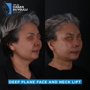 Facelift Before After Photos in Turkey