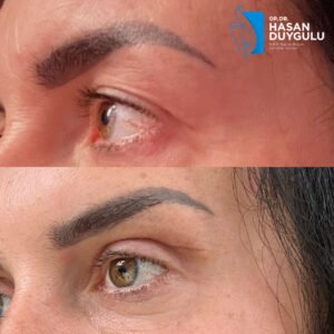 fox-eye-lift-before-and-after