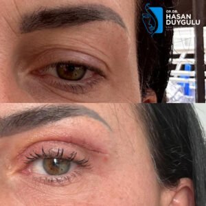 fox-eyes-surgery-in-turkey