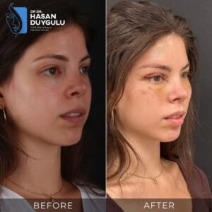 Facelift Before After Photos in Turkey