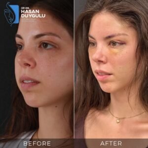 Facelift Before After Photos in Turkey