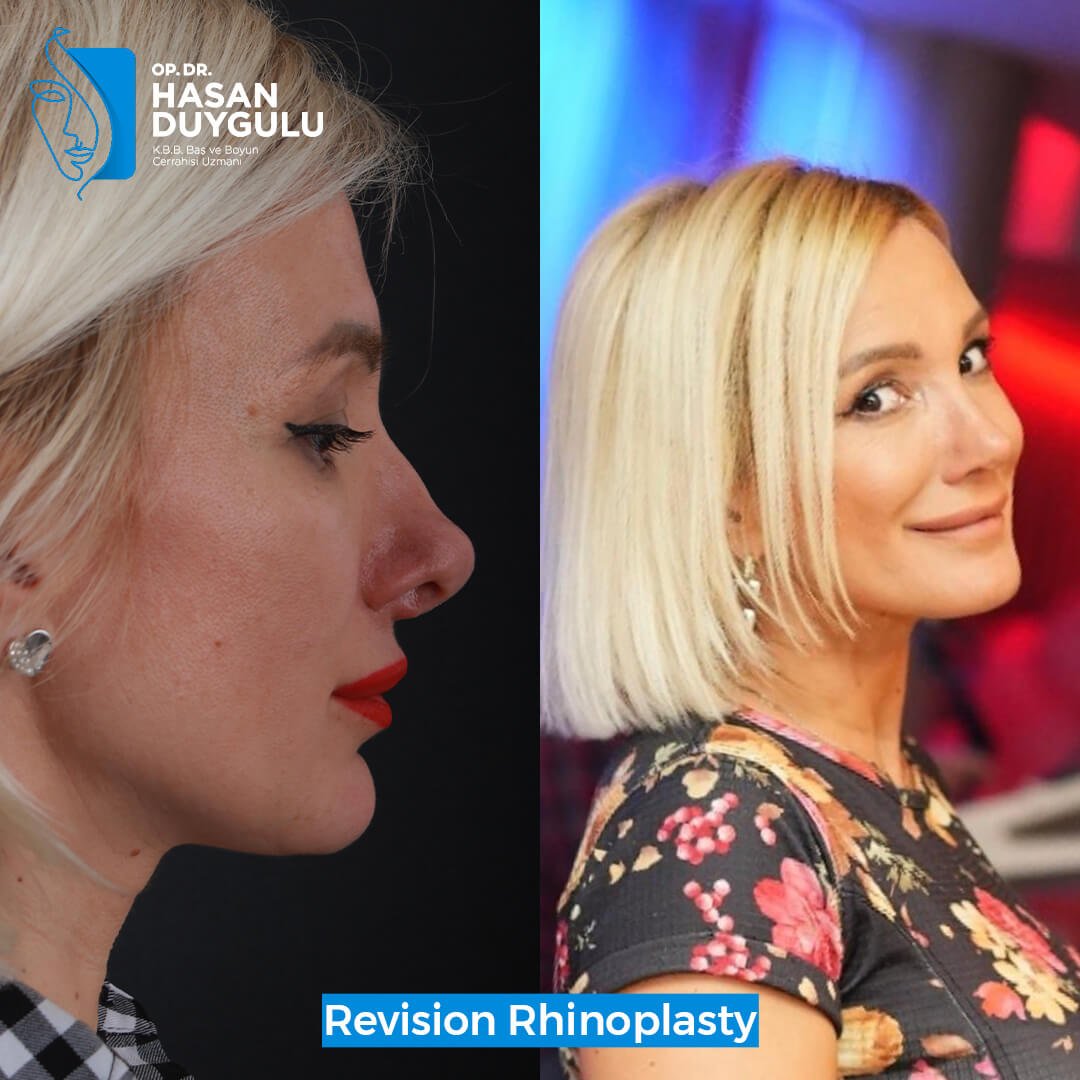 Rhinoplasty Turkey Gallery