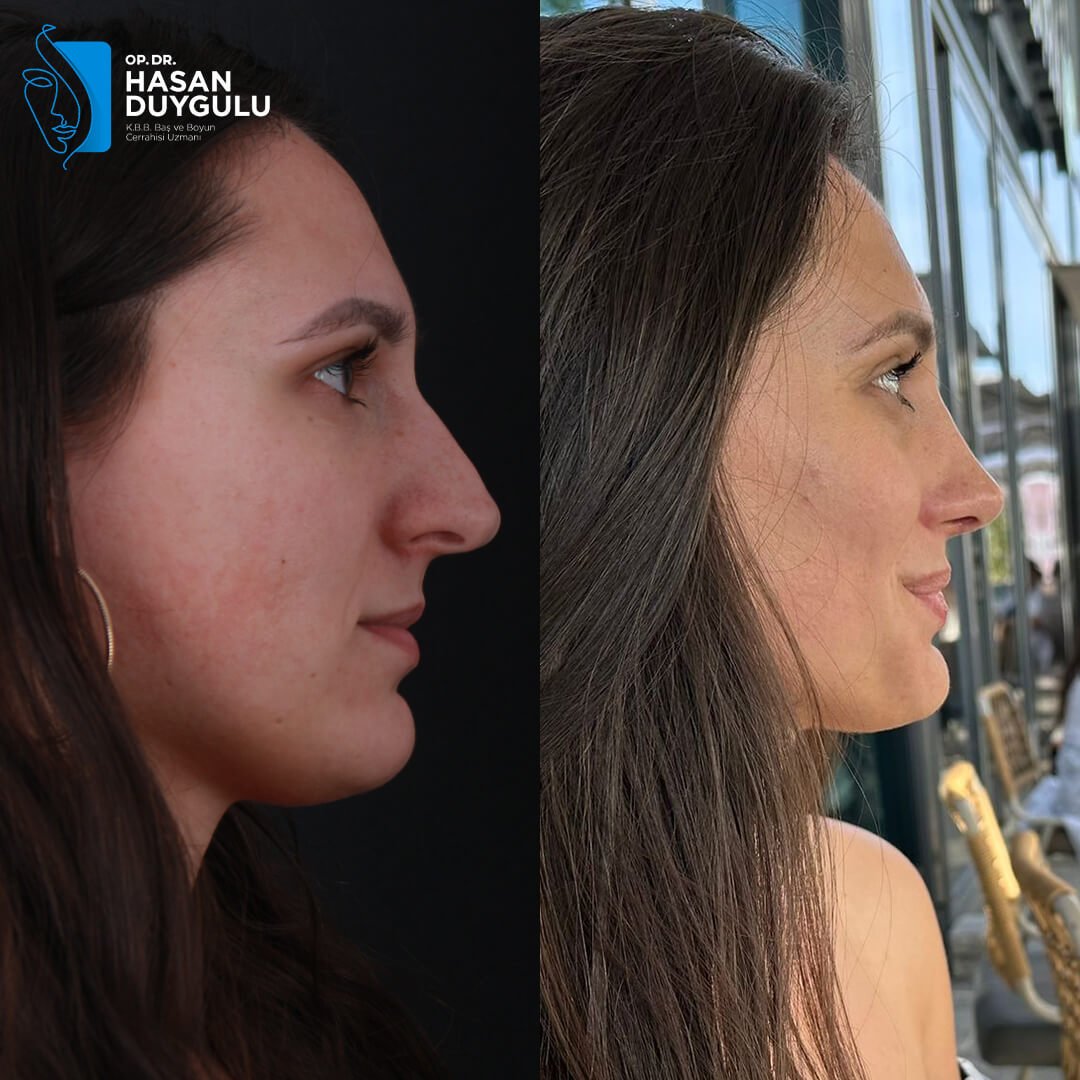 Rhinoplasty Turkey Gallery