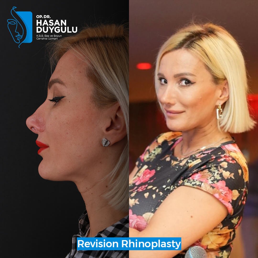 Rhinoplasty Turkey Gallery