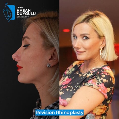 rhinoplasty-nose-surgery-turkey