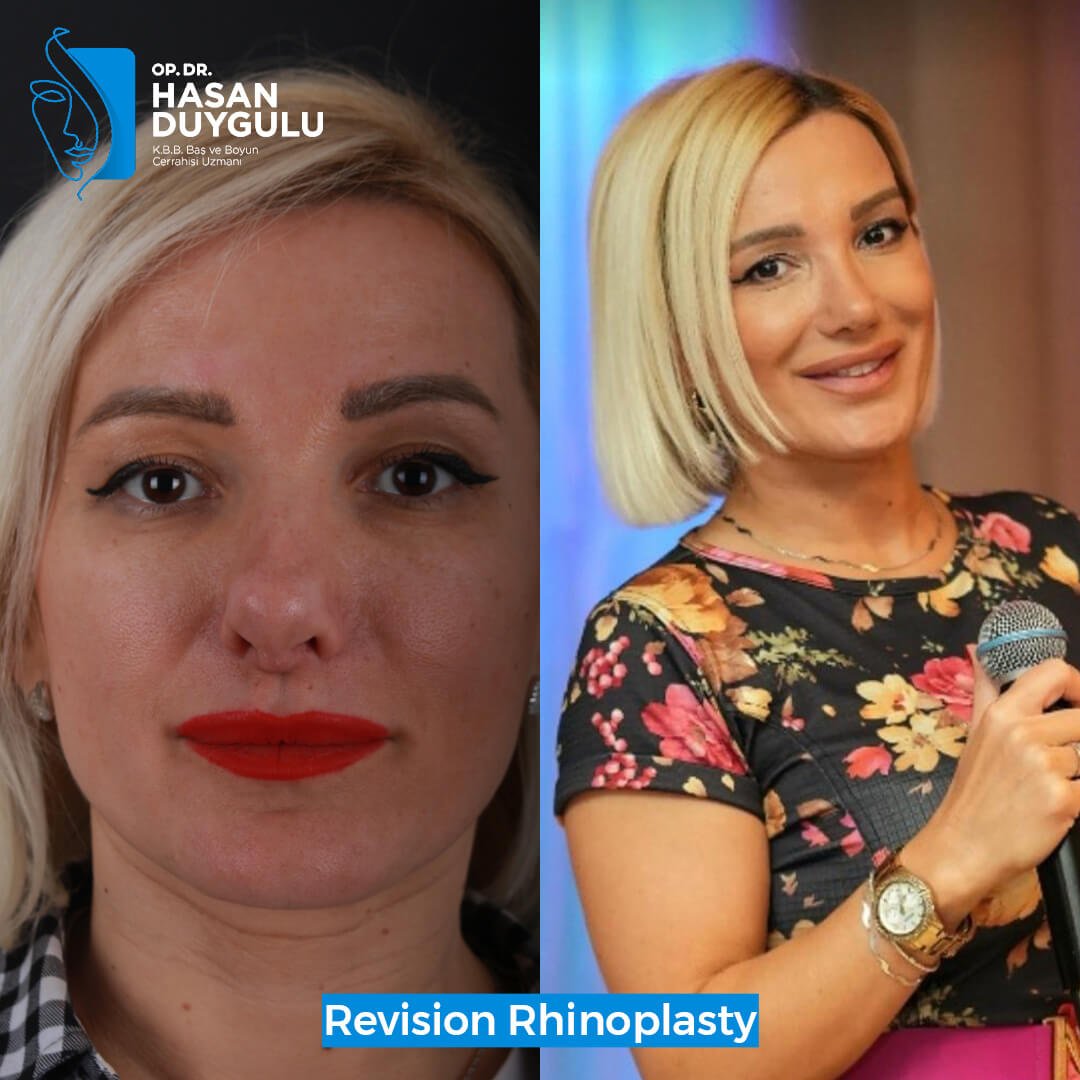 Rhinoplasty Turkey Gallery