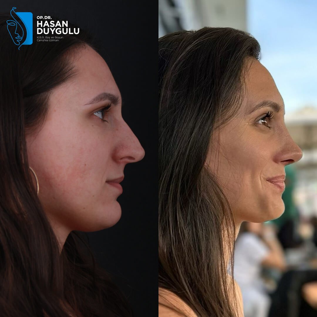 Rhinoplasty Turkey Gallery